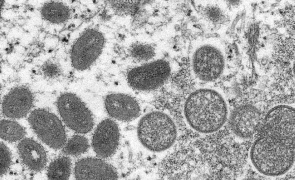 Spain reports second death from monkeypox