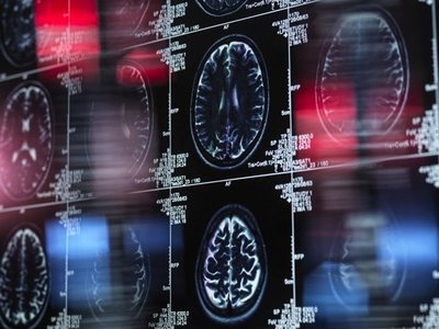 Researchers Find Alarming Link Between Viruses and Neurodegenerative Diseases in Review of Medical Records of 450,000 People