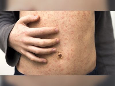 Measles Cases in Europe Soar 45-Fold in 2023, Highlighting Hardest-Hit Nations