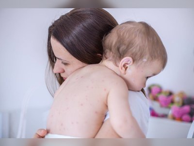 Measles Cases in Europe Soar 45-Fold in 2023, Highlighting Hardest-Hit Nations