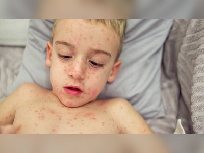 Europe Witnesses 'Alarming Rise' in Measles Cases, UK Declares 'National Incident'