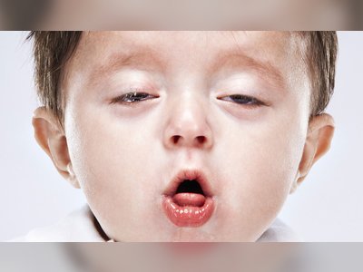Choking cough, respiratory pause, vomiting: This is what the resurging whooping cough looks like